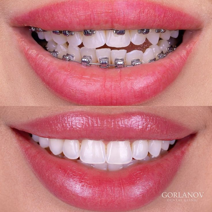 Before and After