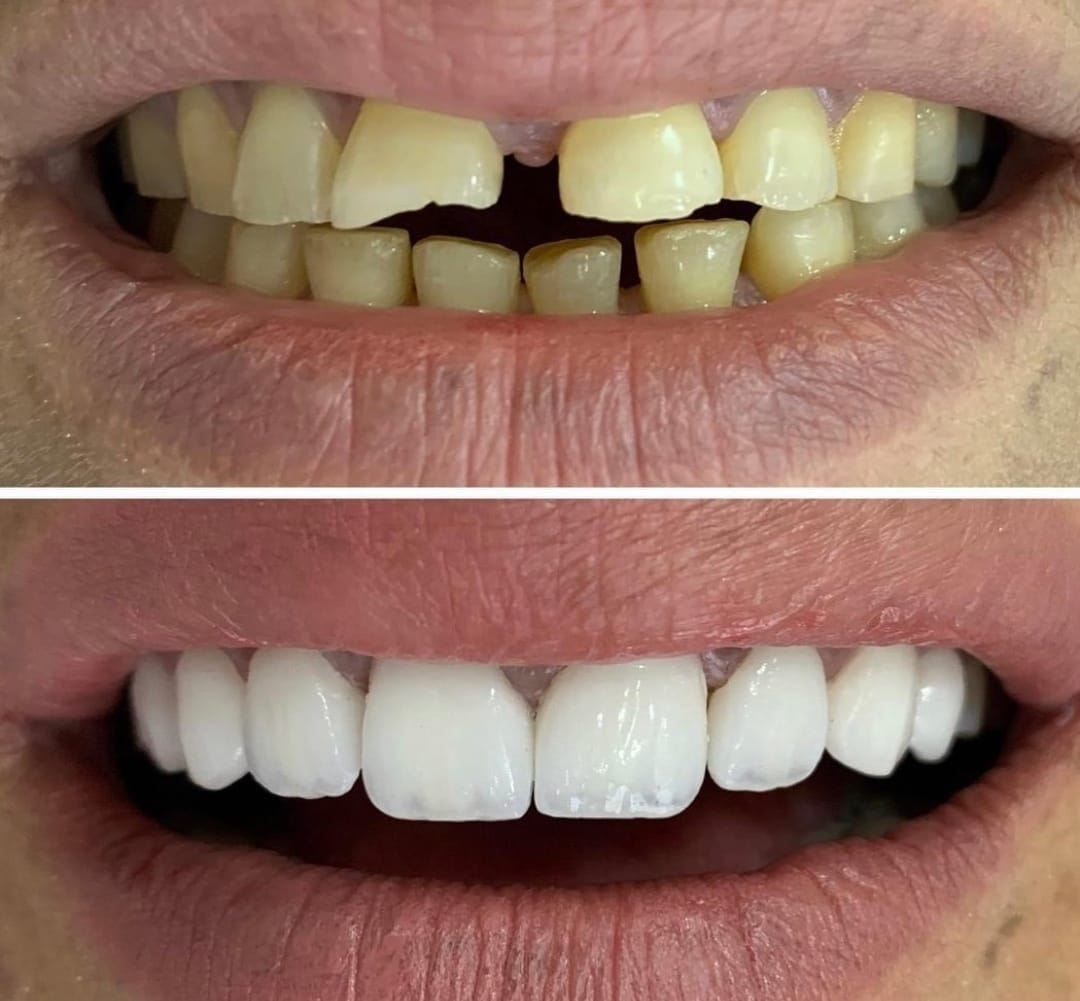 Before and After