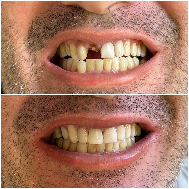 Before and After