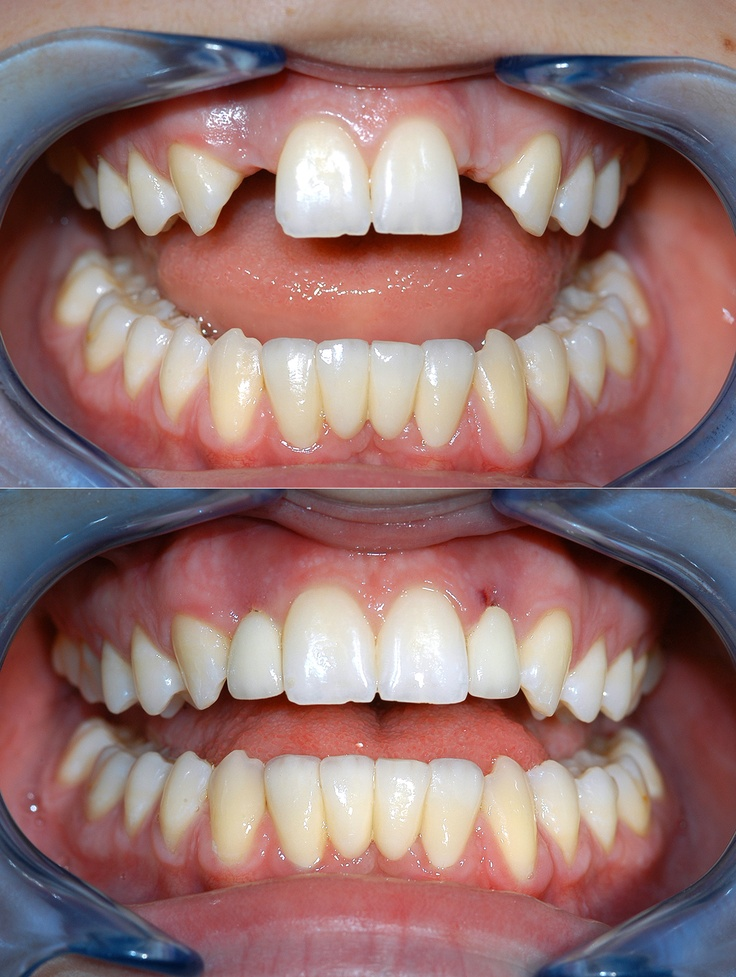 Before and After
