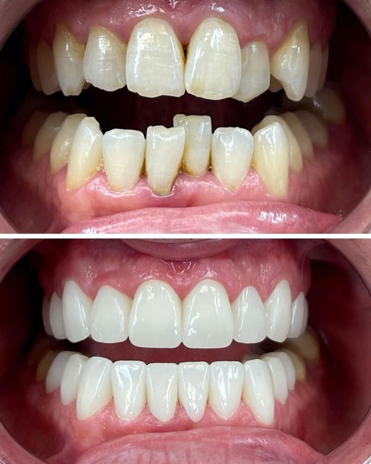 Before and After